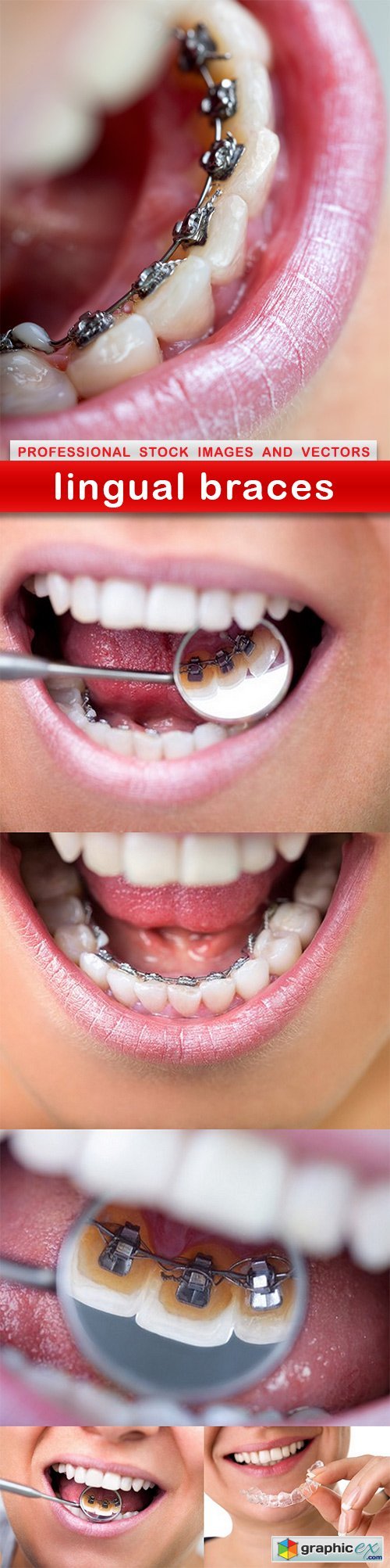 lingual braces - 6 UHQ JPEG